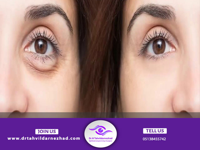 تاثیر لیزر در از بین بردن چین و چروک های دور چشم